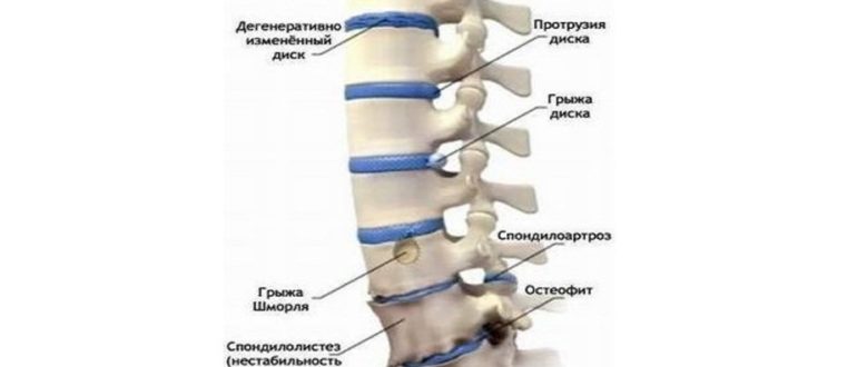 Дистрофические изменения в пояснично-крестцовом отделе
