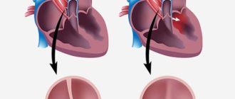 Двустворчатый аортальный клапан