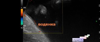 Узи мошонки, паховая грыжа