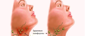 Воспалились лимфоузлы после ангины