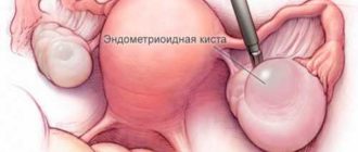 Эндометриоидная киста: тактика лечения и вопросы по ОК