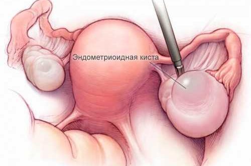 Эндометриоидная киста: тактика лечения и вопросы по ОК