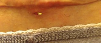 Вокруг незаживающей раны образовалось уплотнение из пузырьков