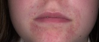 Дисбактериоз, покраснение лица и сыпь, как лечить?