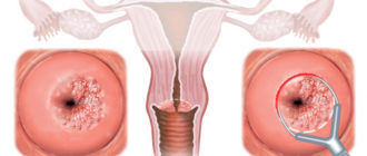Дисплазия, CIN2, ВПЧ, Воспаление
