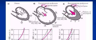 Нарушение диастолической функции ЛЖ и дилатация