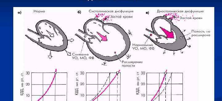 Нарушение диастолической функции ЛЖ и дилатация