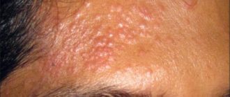 Мелкопапулезная сыпь