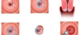 Электроконизация, нужен совет