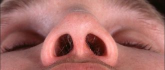 Красная плотная шишка в носовой перегородке