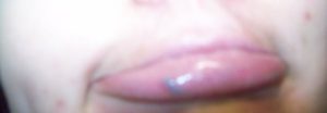 Внутренняя шишка на большой половой губе