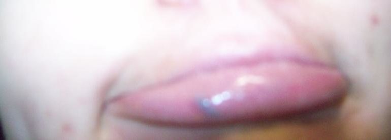 Внутренняя шишка на большой половой губе