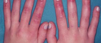 Может ли проявиться муковисцидоз во взрослом возрасте?