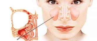 Дополнительная септа в правой гайморовой пазухе