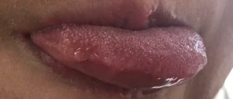 Наросты сбоку языка