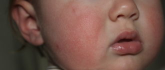 Всегда красные щеки у ребёнка признак алергия?