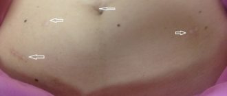 Месячные после лапароскопии