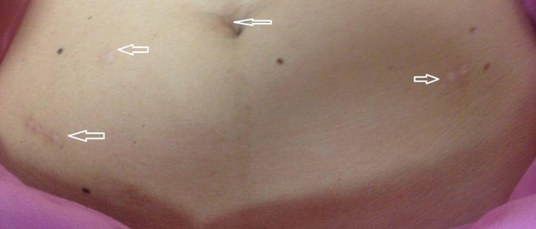 Месячные после лапароскопии