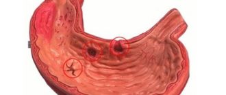 Эритематозная гастродуоденопатия