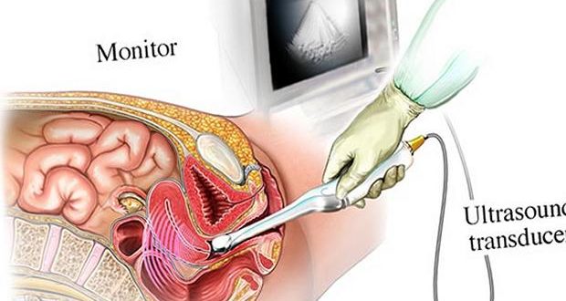 Девственность через УЗИ