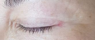 Красная кожа от века до шва после блефаропластики