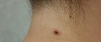 Электрокоагуляция изменившейся родинки