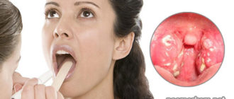 Мучает слизь в горле после операции