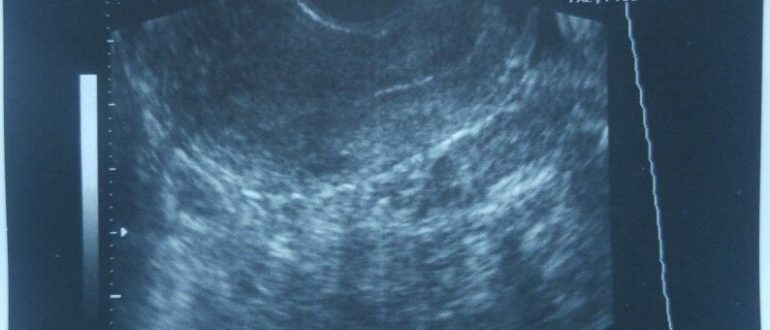 УЗИ не показало беременность