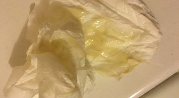 Выделение коричневого цвета на 33 неделе беременности