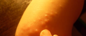 Водяные прыщики на коленках