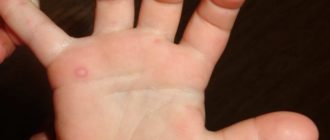 Единичный волдырь на ладони у ребенка