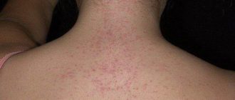 Крапивница в виде высыпания на груди и спине