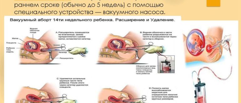 Верно ли назначено лечение после выкидыша
