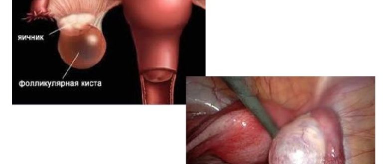Можно ли заниматься спортом с кистой яичника