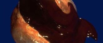 Эндометриоидные кисты