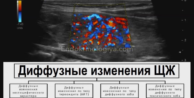 Диффузные изменения щитовидной железы