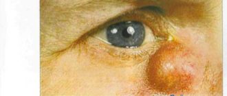 Эктазия слезного мешка