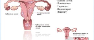 Можно ли использовать тампоны с мазью вишневого при месячных? Диагноз обострение хронического сальпингоофорита.