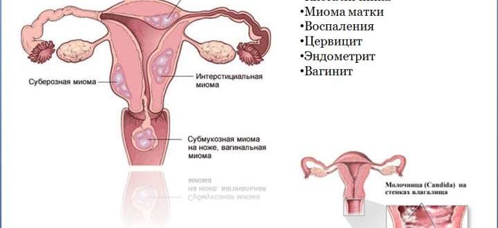 Можно ли использовать тампоны с мазью вишневого при месячных? Диагноз обострение хронического сальпингоофорита.