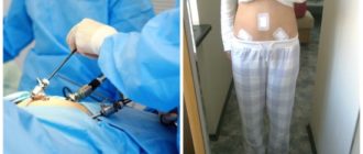 Две недели после лапароскопии, а боли продолжаютя