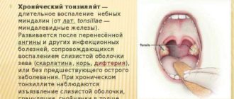 Можно ли заниматься спортом про хрон. Тонзиллите?