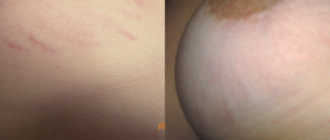 Что делать при розтяжках на груди в возрасте 14 лет?