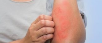Крапивница не проходит 4 месяца
