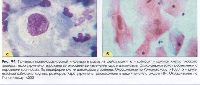 ВПЧ и онкоцитология