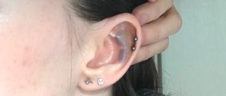 На ушке после прокола образовалась похожее на гематомку