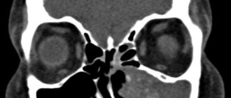 Мицетома верхнечелюстной пазухи