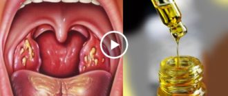 Может ли при ангине пропасть голос?