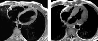 Мрт после стентирования