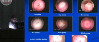Дисплазия шейки матки лечение методом ФТД