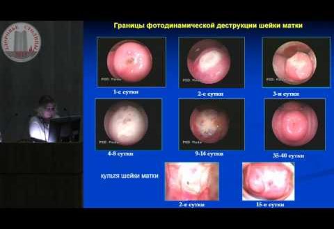 Дисплазия шейки матки лечение методом ФТД